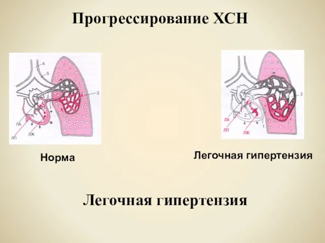 Прогрессирование ХСН Норма Легочная гипертензия Легочная гипертензия