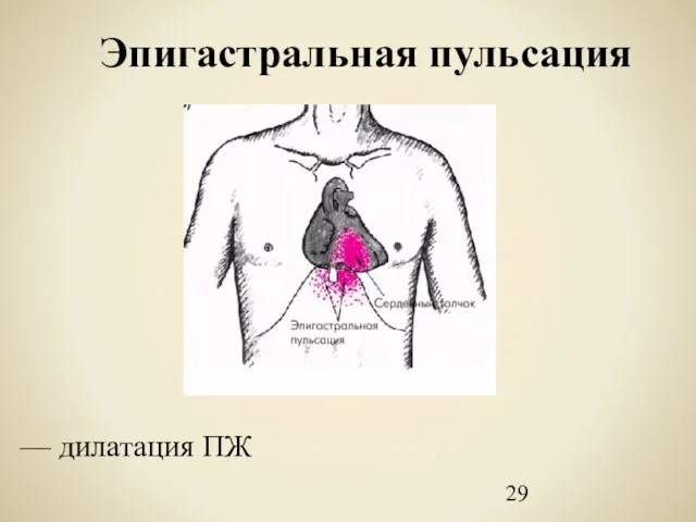 Эпигастральная пульсация — дилатация ПЖ