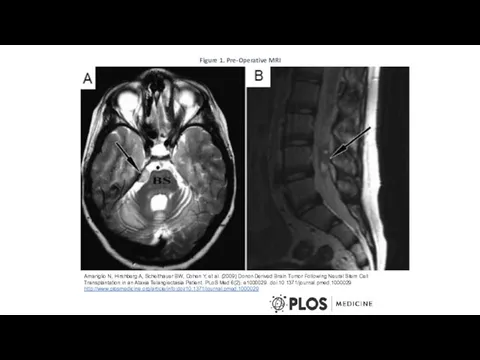 Figure 1. Pre-Operative MRI Amariglio N, Hirshberg A, Scheithauer BW, Cohen