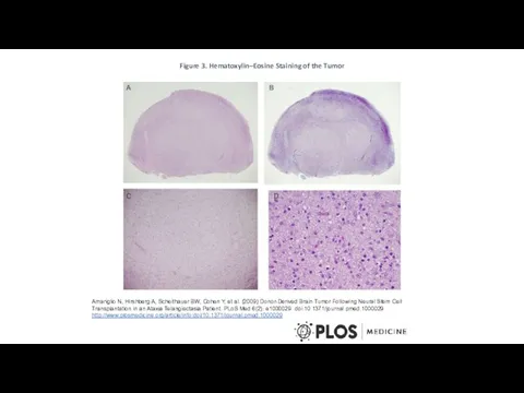 Figure 3. Hematoxylin–Eosine Staining of the Tumor Amariglio N, Hirshberg A,