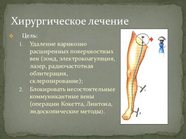 Цель: Удаление варикозно расширенных поверхностных вен (зонд, электрокоагуляция, лазер, радиочастотная облитерация,