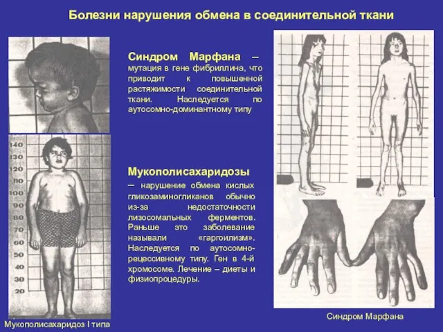 Болезни нарушения обмена в соединительной ткани Мукополисахаридоз I типа Синдром Марфана