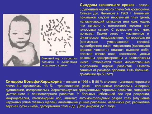 Синдром «кошачьего крика» - связан с делецией короткого плеча 5-й хромосомы.