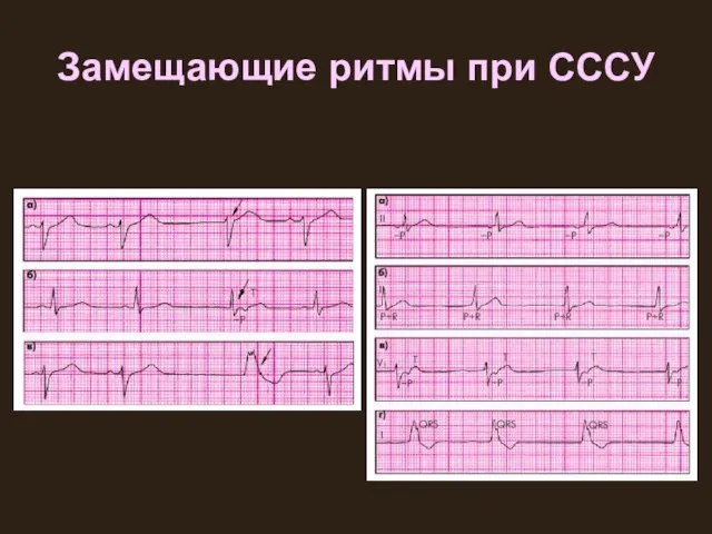 Замещающие ритмы при СССУ