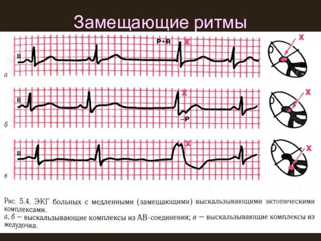 Замещающие ритмы