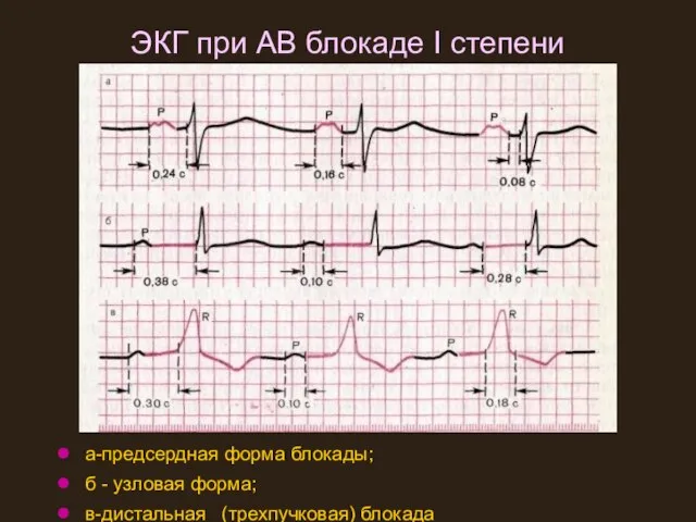 ЭКГ при АВ блокаде I степени а-предсердная форма блокады; б - узловая форма; в-дистальная (трехпучковая) блокада