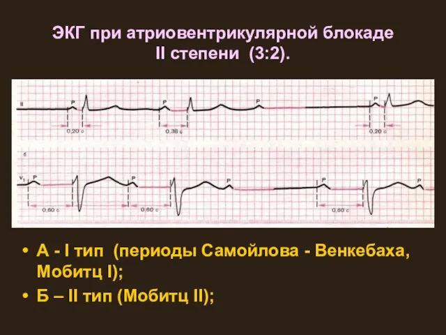 ЭКГ при атриовентрикулярной блокаде II степени (3:2). А - I тип