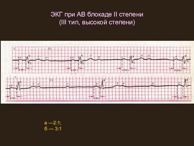 ЭКГ при АВ блокаде II степени (III тип, высокой степени) а —2:1; б — 3:1