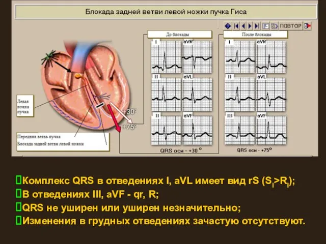 Комплекс QRS в отведениях I, aVL имеет вид rS (SI>RI); В