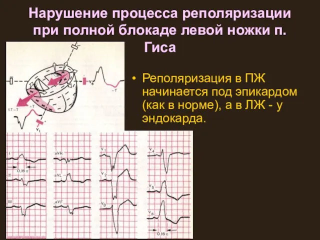 Нарушение процесса реполяризации при полной блокаде левой ножки п.Гиса Реполяризация в