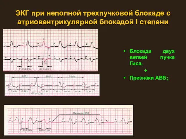 ЭКГ при неполной трехпучковой блокаде с атриовентрикулярной блокадой I степени Блокада