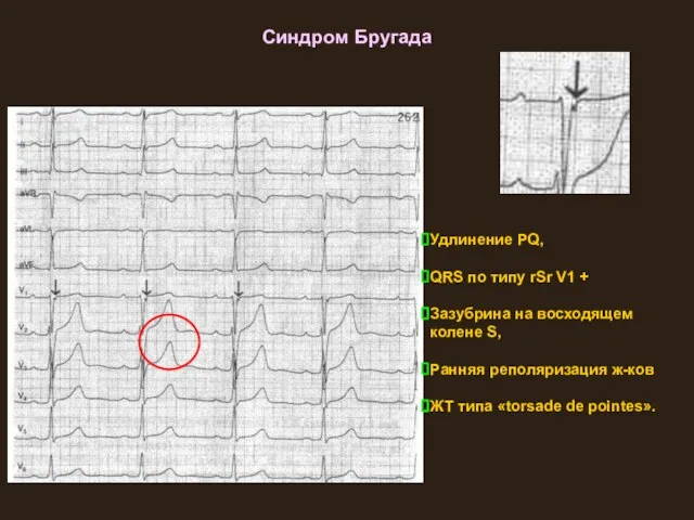 Синдром Бругада Удлинение PQ, QRS по типу rSr V1 + Зазубрина