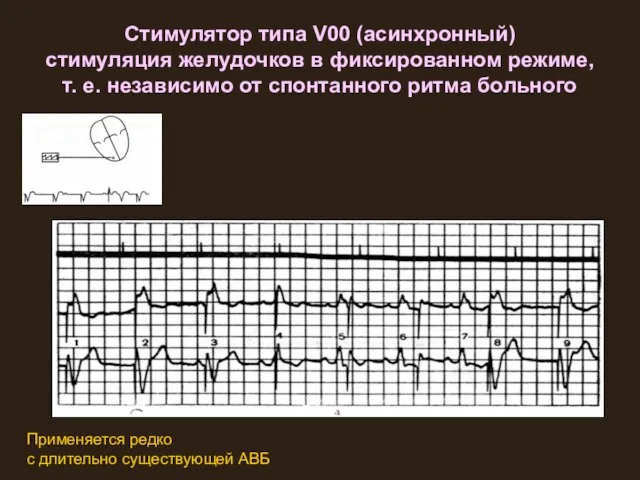 Стимулятор типа V00 (асинхронный) стимуляция желудочков в фиксированном режиме, т. е.