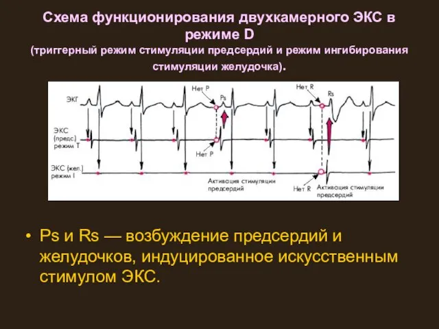 Схема функционирования двухкамерного ЭКС в режиме D (триггерный режим стимуляции предсердий