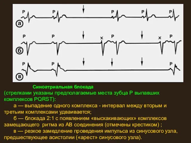 Синоатриальная блокада (стрелками указаны предполагаемые места зубца Р выпавших комплексов PQRST):