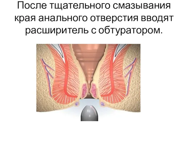 После тщательного смазывания края анального отверстия вводят расширитель с обтуратором.