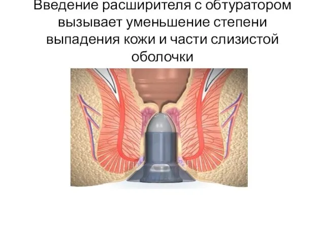 Введение расширителя с обтуратором вызывает уменьшение степени выпадения кожи и части слизистой оболочки