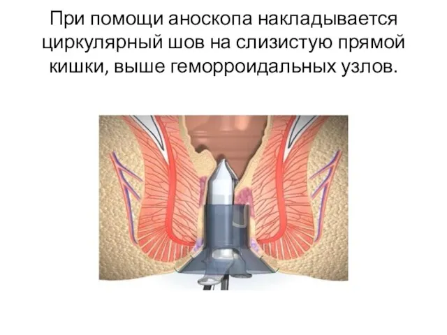 При помощи аноскопа накладывается циркулярный шов на слизистую прямой кишки, выше геморроидальных узлов.