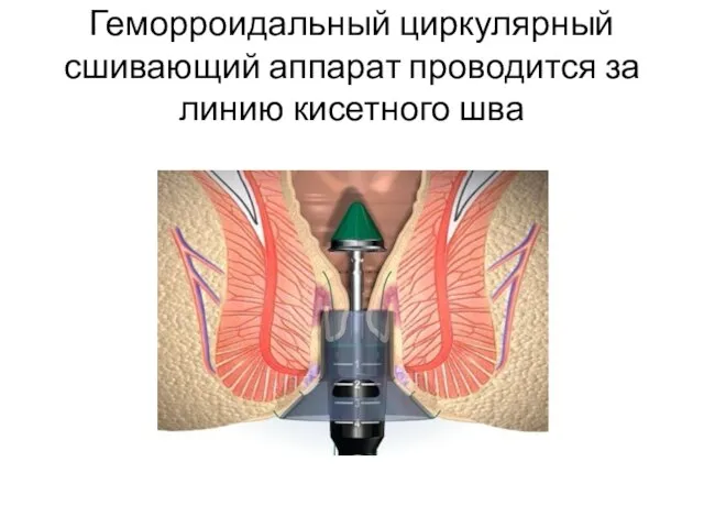 Геморроидальный циркулярный сшивающий аппарат проводится за линию кисетного шва