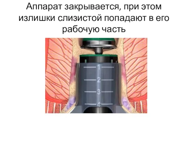 Аппарат закрывается, при этом излишки слизистой попадают в его рабочую часть