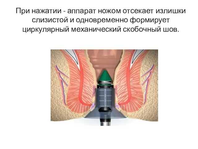 При нажатии - аппарат ножом отсекает излишки слизистой и одновременно формирует циркулярный механический скобочный шов.