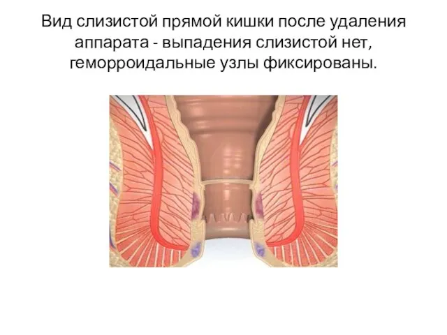 Вид слизистой прямой кишки после удаления аппарата - выпадения слизистой нет, геморроидальные узлы фиксированы.