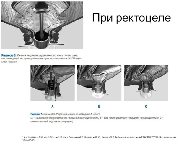 При ректоцеле Д.м.н. Кузьминов А.М., проф. Орлова Л. П., к.м.н. Зароднюк