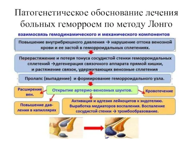 Патогенетическое обоснование лечения больных геморроем по методу Лонго