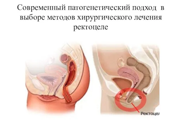 Современный патогенетический подход в выборе методов хирургического лечения ректоцеле