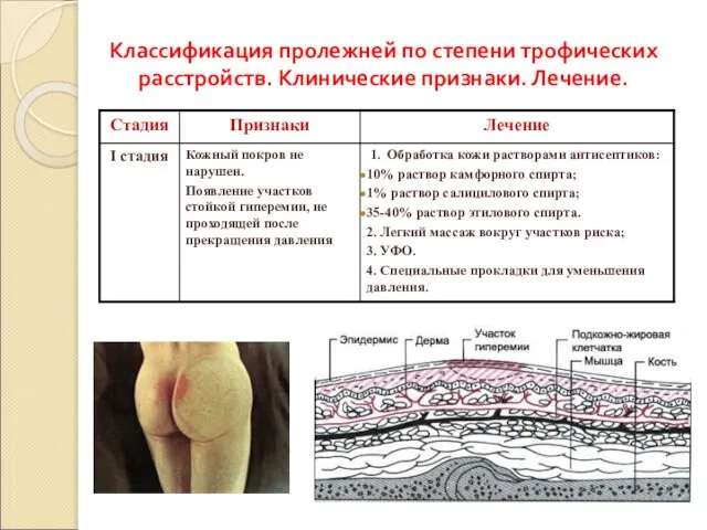 Классификация пролежней по степени трофических расстройств. Клинические признаки. Лечение.