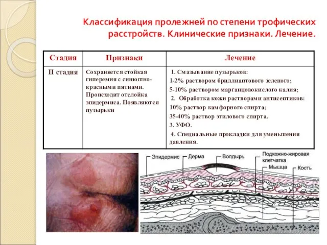 Классификация пролежней по степени трофических расстройств. Клинические признаки. Лечение.