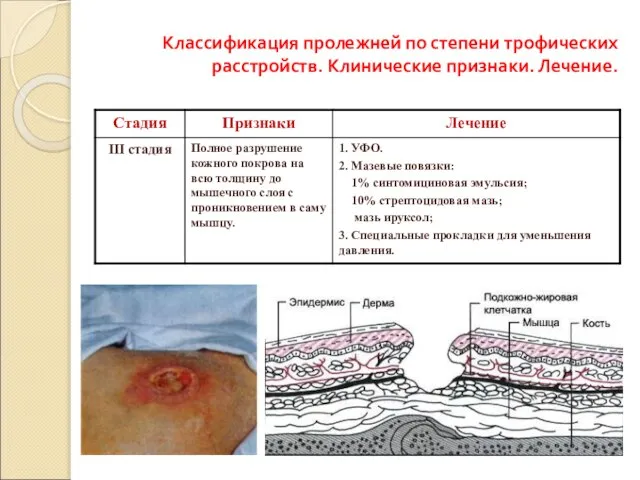 Классификация пролежней по степени трофических расстройств. Клинические признаки. Лечение.