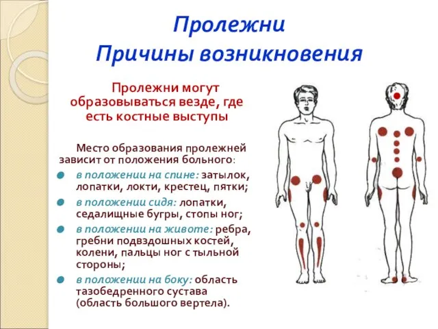 Пролежни Причины возникновения Пролежни могут образовываться везде, где есть костные выступы