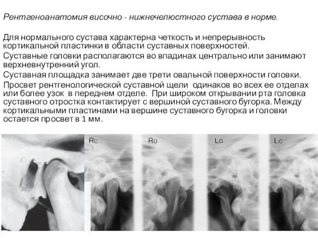 Рентгеноанатомия височно - нижнечелюстного сустава в норме. Для нормального сустава характерна