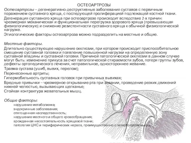 ОСТЕОАРТРОЗЫ Остеоартрозы – дегенеративно-деструктивные заболевания суставов с первичным поражением суставного хряща,