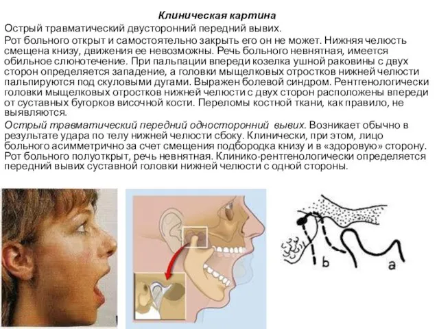 Клиническая картина Острый травматический двусторонний передний вывих. Рот больного открыт и