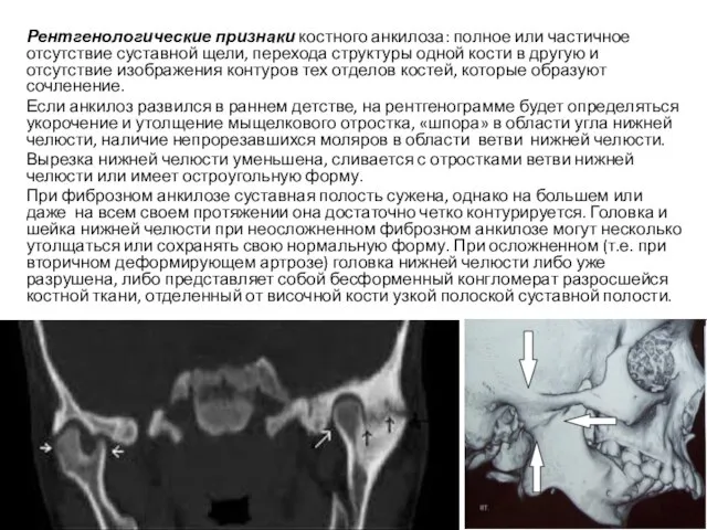 Рентгенологические признаки костного анкилоза: полное или частичное отсутствие суставной щели, перехода