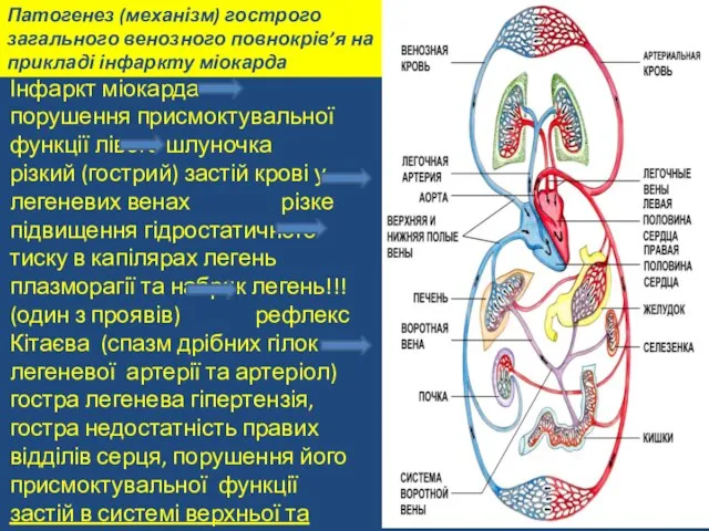 Патогенез (механізм) гострого загального венозного повнокрів’я на прикладі інфаркту міокарда Інфаркт