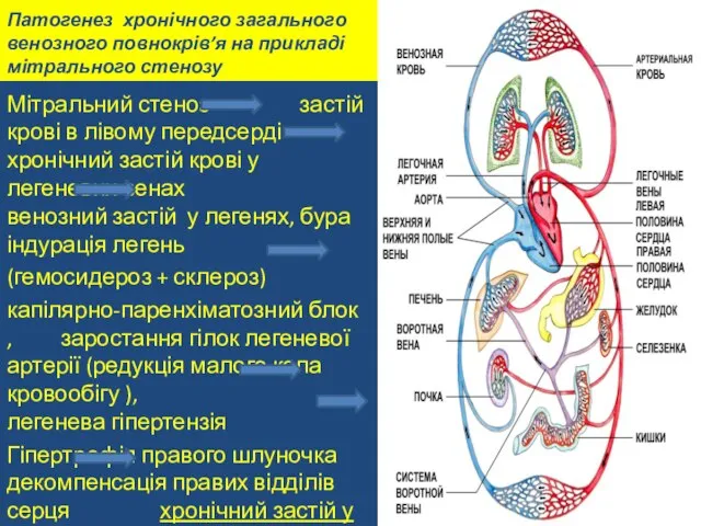 Патогенез хронічного загального венозного повнокрів’я на прикладі мітрального стенозу Мітральний стеноз