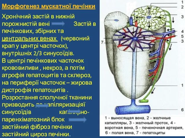 Морфогенез мускатної печінки Хронічний застій в нижній порожнистій вені Застій в