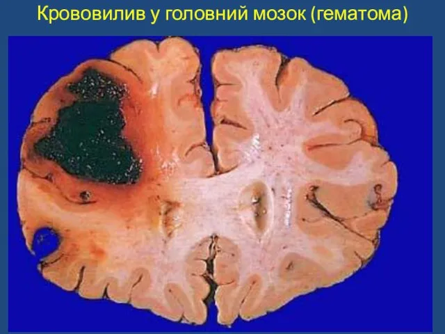 Крововилив у головний мозок (гематома)