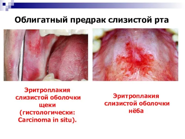 Облигатный предрак слизистой рта Эритроплакия слизистой оболочки щеки (гистологически: Carcinoma in situ). Эритроплакия слизистой оболочки нёба