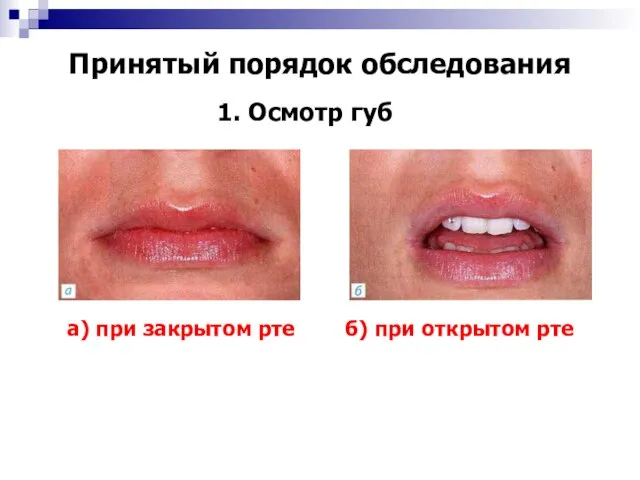 Принятый порядок обследования 1. Осмотр губ а) при закрытом рте б) при открытом рте