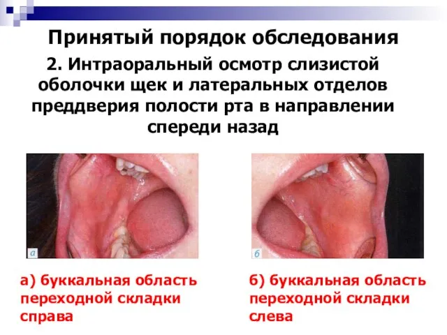 Принятый порядок обследования 2. Интраоральный осмотр слизистой оболочки щек и латеральных