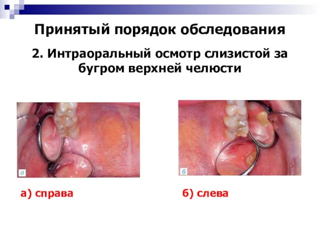 Принятый порядок обследования 2. Интраоральный осмотр слизистой за бугром верхней челюсти а) справа б) слева