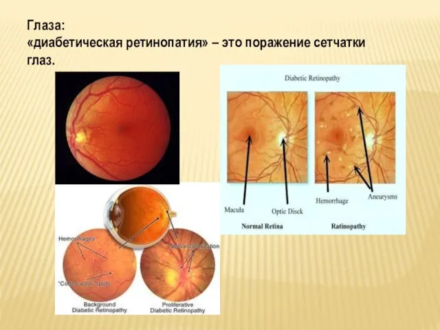 Глаза: «диабетическая ретинопатия» – это поражение сетчатки глаз.