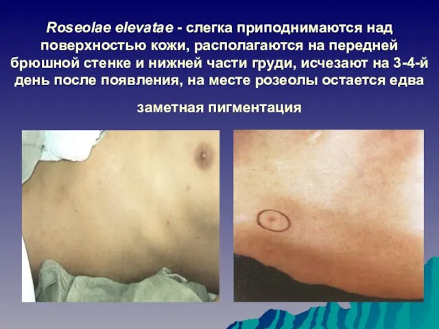 Roseolae elevatae - слегка приподнимаются над поверхностью кожи, располагаются на передней