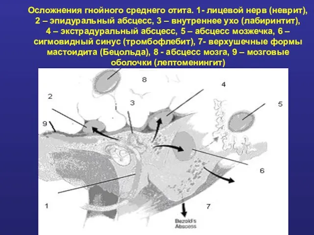 Осложнения гнойного среднего отита. 1- лицевой нерв (неврит), 2 – эпидуральный