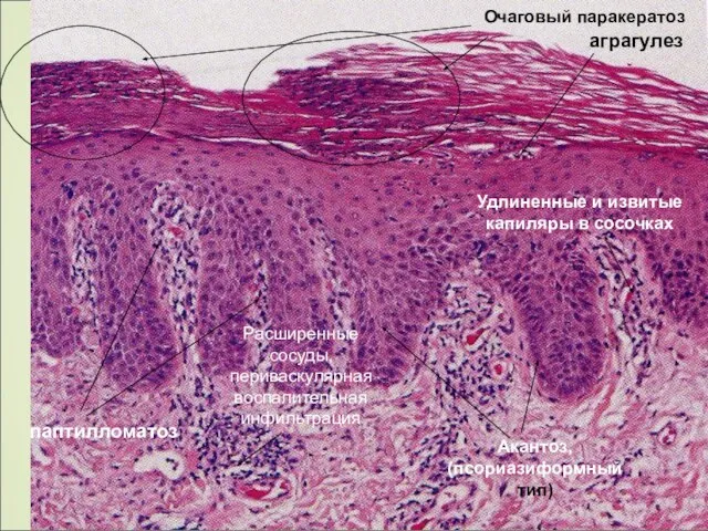 Очаговый паракератоз аграгулез Акантоз, (псориазиформный тип) паптилломатоз Удлиненные и извитые капиляры