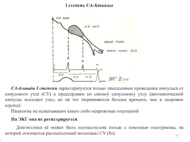 СА-блокада I степени характеризуется только замедлением проведения импульса от синусового узла